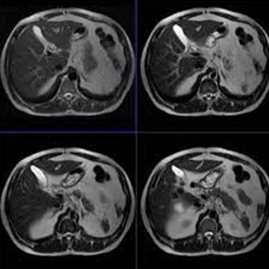 MRI Upper Abdomen and MRCP